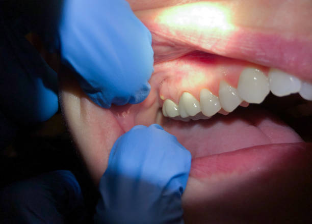 Best Emergency Wisdom Tooth Extraction in The Galena Territory, IL
